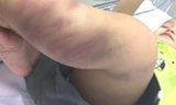Bé trai 1 tuổi nhập viện trong tình trạng hôn mê, co giật, mắt bị giãn, bầm tím toàn thân và xây xước ở bộ phận sinh dục, cổ.