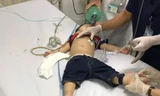 Bé trai 22 tháng tuổi ngưng tim, ngưng thở vì hóc thạch rau câu
