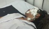 Sinh viên V.T.H đang cấp cứu tại bệnh viện trong tình trạng bỏng nặng ở mắt. Ảnh L.V.