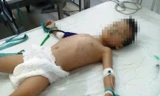 Cháu L. điều trị tại bệnh viện trong tình trạng nguy kịch tính mạng