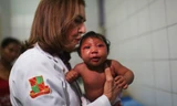 Một em bé bị dị tật đầu nhỏ do virus zika