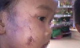 Bảo vệ bé gái bị bạo hành, cô giáo đối diện án kỷ luật