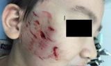 Một ca trẻ bị chó cắn gây tổn thương nặng vùng mặt điều trị tại Bệnh viện Nhi đồng 1 TPHCM. Ảnh: V.Đ