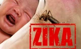 Virus Zika do muỗi truyền liên quan bệnh đầu nhỏ, viêm não tủy cấp, Guillain-Barre. Ảnh: Getty Images