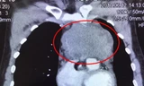 Phẫu thuật lấy khối u 'khủng' trong lồng ngực bệnh nhân