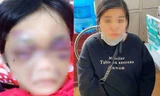 Điều tra vụ bé gái 6 tuổi ở Hải Dương bị mẹ bạo hành phải nhập viện
