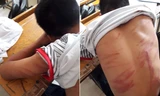 Bé trai lớp 8 nghi bị bố đánh đập phải nhập viện