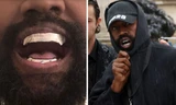 Kanye West gây sốc khi nhổ hết răng thật