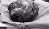 Lấy khối u nặng hơn 4 kg khỏi cơ thể người phụ nữ tại Cần Thơ 