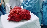 Khối u nặng 4,3kg lấy ra khỏi cơ thể bệnh nhân. Ảnh: Lao Động