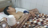 Bệnh nhân bị cụt tay