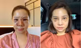 Nữ diễn viên đăng ảnh mặt sưng phồng sau dao kéo. Ảnh: FBNV. 