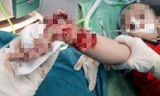 Người lớn lơ là, bé trai 3 tuổi bị máy xay thịt nghiền nát cánh tay