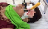 Người phụ nữ nhập viện với con dao đâm thấu não