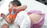 Khi ra đời, khối u trên người bé chỉ nhỏ bằng quả nho nhưng do không có tiền chữa trị, khối u lớn dần