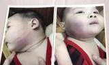 Bé Hồng Anh bầm tím sau khi gia đình đón từ nhà trẻ về. Ảnh: Đào Phan