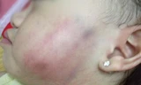 Vết bầm trên má bé 16 tháng tuổi khi gia đình đón về vào chiều 26/5.