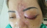 Nữ bệnh nhân bị mù mắt sau 5 phút tiêm filler.