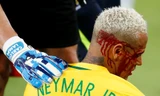 Neymar bị rách mí mắt ở trận đấu với Bolivia.