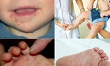 Dịch chân tay miệng có chiều hướng tăng cao