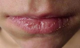 Môi của bệnh nhân bị kích ứng cho sử dụng son kém chất lượng. Ảnh: TH.
