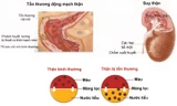 Người bệnh có thể tử vong do suy thận mạn