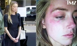 Gương mặt thâm tím của Amber Heard tại tòa án. Ảnh: TMZ, Splash.