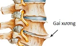 Thoái hóa đĩa đệm cột sống là một nguyên nhân hình thành gai xương cột sống