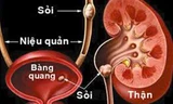 Vì sao uống nhiều nước giúp ngừa sỏi thận?