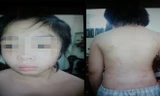 Những vết thương trên người cháu K.
