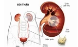 Những biến chứng của bệnh sỏi thận