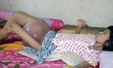 Cảm thương người phụ nữ có khối u nặng gần 10kg ở đùi