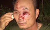 Anh Hảo bị côn đồ đánh rách mặt.