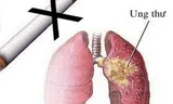 8 bệnh ung thư do hút thuốc lá