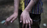Đôi tay bị biến dạng do tra tấn của một trong hai thiếu nữ Myanmar. Ảnh: AFP.