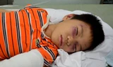 Bé trai 6 tuổi bị cha dượng đánh bầm dập, gãy tay chân