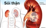Bệnh sỏi thận rất dễ tái phát