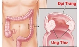 Ung thư đại tràng là bệnh gây tử vong hàng đầu trong các loại ung thư