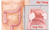 Ung thư đại tràng là bệnh gây tử vong hàng đầu trong các loại ung thư