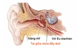Nguy cơ suy giảm thính lực do viêm tai giữa