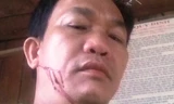 Kiểm lâm viên Nguyễn Thà với vết rách dài do bị đối tượng lâm tặc hành hung