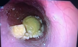 Ảnh nội soi mật heo trong lòng thực quản bệnh nhân. 
