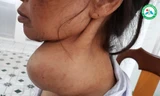 Bà Y V. với khối u đeo nặng trên cổ trước khi mổ