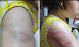 Gia đình cháu bé chia sẻ hình ảnh cháu bị cô giáo đánh tím vai - Ảnh: Hoàng Long