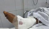 Chân phải bệnh nhân Nguyễn Văn Thảo (37 tuổi, trú huyện Ứng Hoà) bị mổ nhầm do bác sĩ bệnh viện Việt Đức không đọc bệnh án. Ảnh: Nguyễn Hoàn.