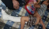 Tai nạn trong Trường tiểu học Nam Trung Yên khiến cháu Kiên bị gãy xương đùi