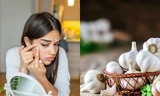 Phương pháp trị mụn bằng tỏi đang "viral" trên Tóp Tóp có thực sự hiệu quả?