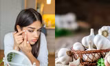 Phương pháp trị mụn bằng tỏi đang "viral" trên Tóp Tóp có thực sự hiệu quả?