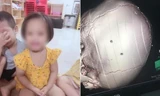 Gia đình bé gái bị đóng đinh vào đầu cho biết bé có sự chuyển biến rõ rệt về sức khỏe
