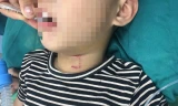 Bé 3 tuổi bị chó cắn rách vùng cổ, thủng khí quản
